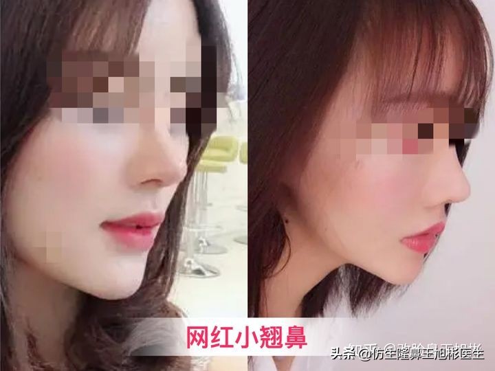 怎么做鼻尖可以做得更高,鼻尖塑形鼻头抬高