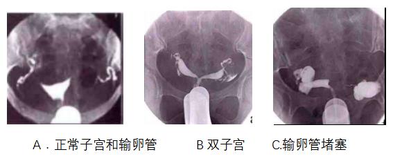 输卵管检查通液和造影的区别,检查输卵管是否通