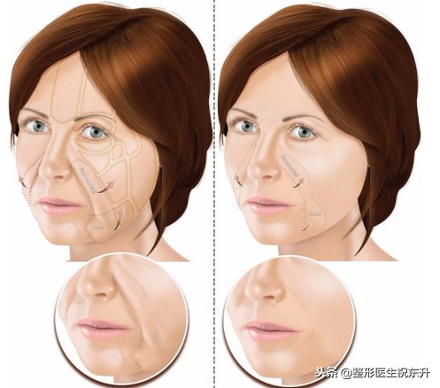 消除法令纹做什么项目,消除法令纹按什么穴