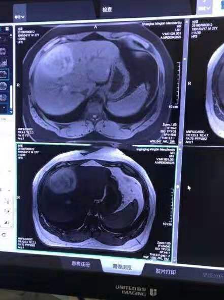 主播pdd肿瘤,pdd直播透露身上发现12颗肿瘤