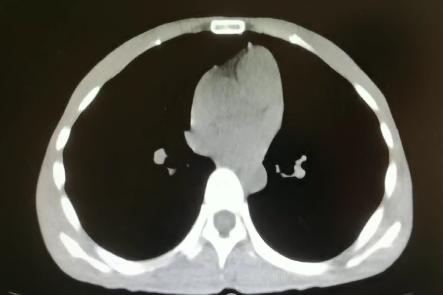 重度高碳酸血症突出表现,出现消化系统疾病的临床表现