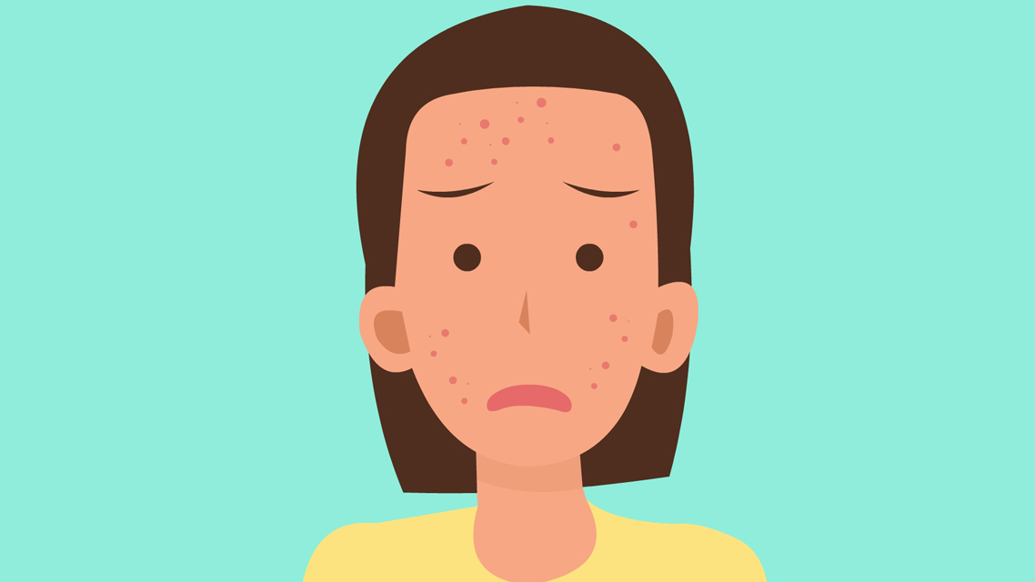 面部激素依赖性皮炎吃什么药,什么叫做面部激素依赖性皮炎