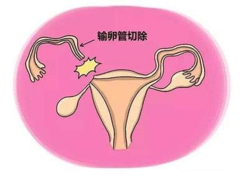 怀孕40天发现宫外孕要如何处理,发现宫外孕40天