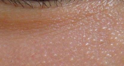 鐚剛鑲矑鎬庝箞娑堥櫎,娑堥櫎鑴傝偑绮掔殑濡欐嫑