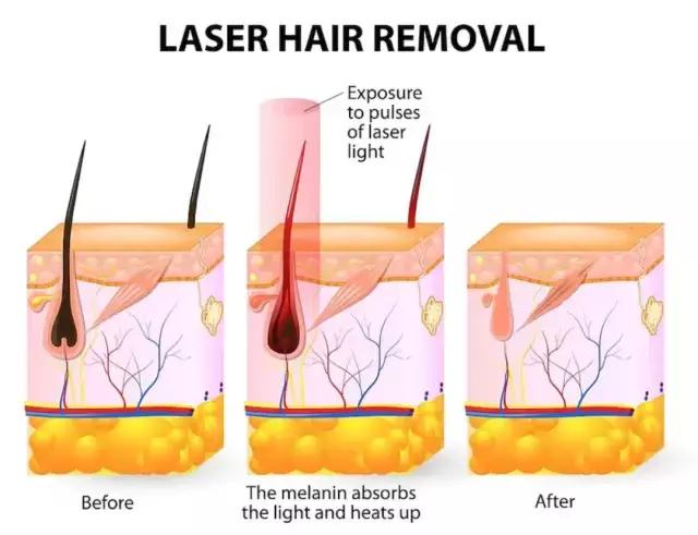 8种脱毛方法了解一下,我试过的5种脱毛方法哪种最有效