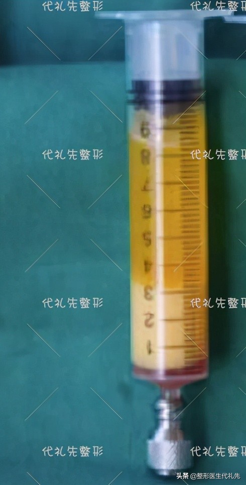 眼袋泪沟填充用什么方法最好,泪沟填充多了像眼袋怎么办