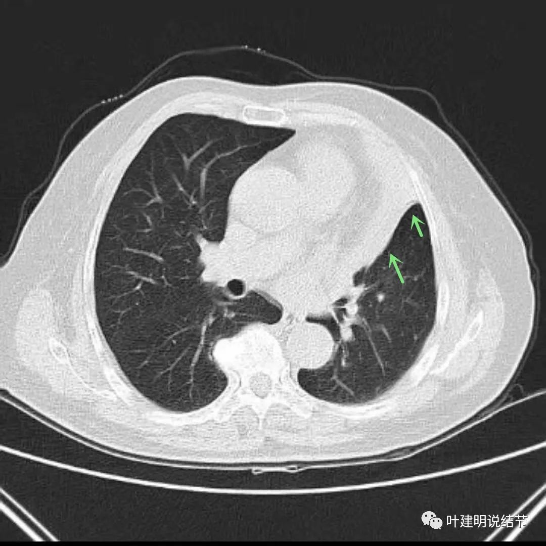 高龄肺癌靶向治疗效果,高龄老人肺癌早期适合放疗吗