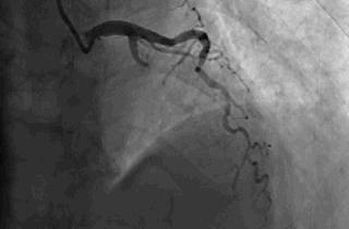 32岁北大博士心梗猝死,知名医生突发心梗
