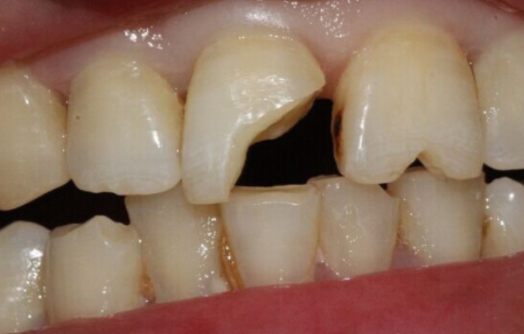 上门牙掉了一块怎么修复,牙磕碰掉了一小块怎么修复