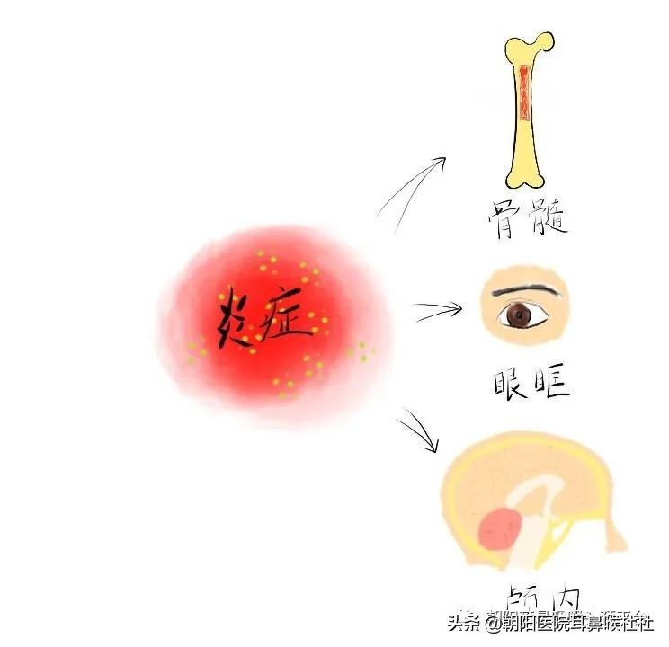 急性鼻窦炎头痛早上轻午后重,头痛鼻窦炎