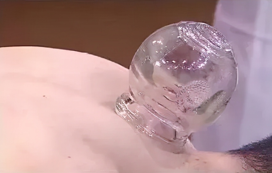 拔罐作用有那么大吗,拔罐的效果有多神奇