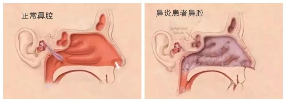 怎么正确洗鼻全过程,洗鼻真的很舒服吗