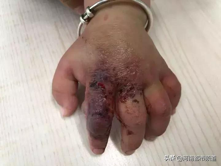 10个月大宝宝手背突然肿了,自制驱蚊神仙水