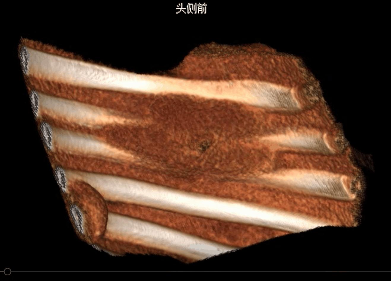 结核杆菌会引起肺结节吗,肺结节诊断为肺结核