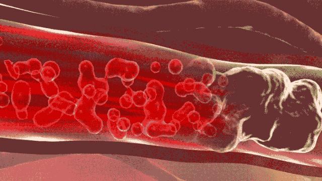 血管堵塞动态图片,血管疏通动图