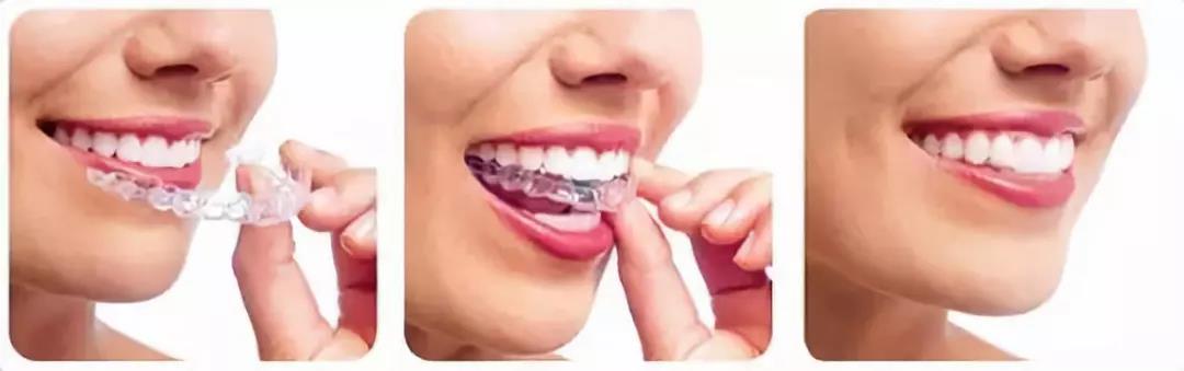 国家有关于牙齿的补贴吗,牙齿补贴报销政策