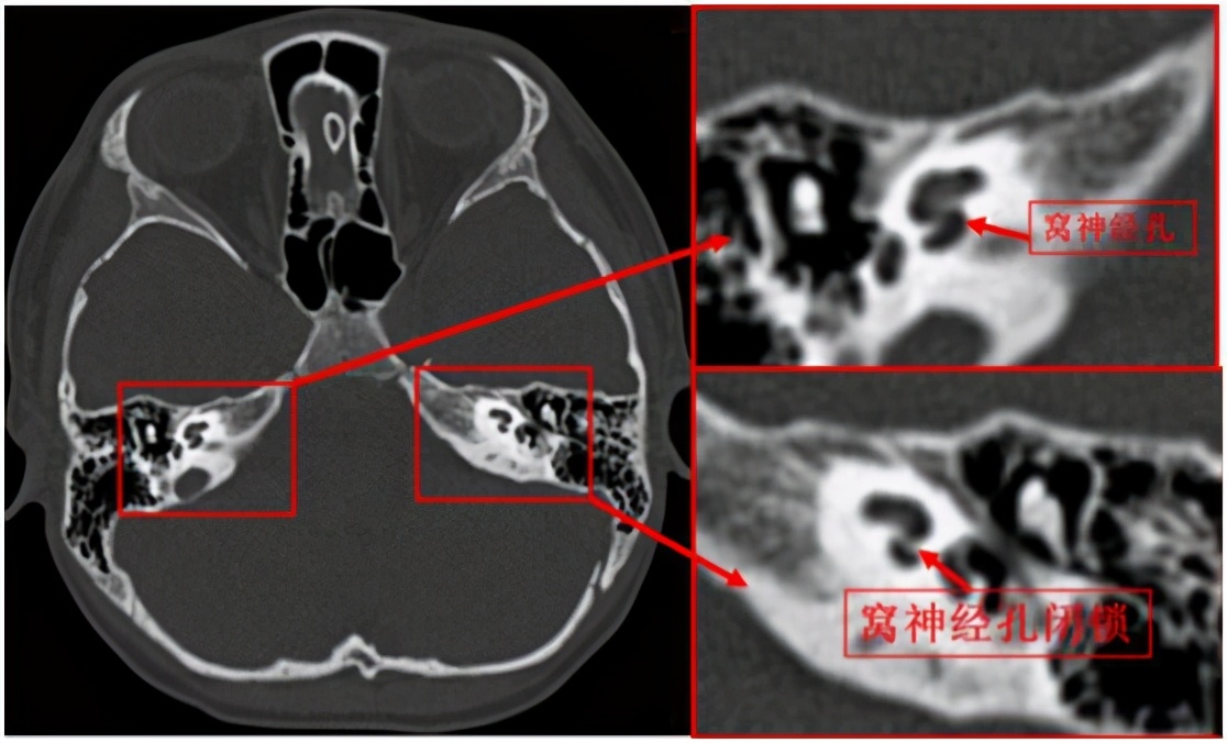爱耳日听力突然下降怎么办,孩子听力下降是耳蜗出现问题吗