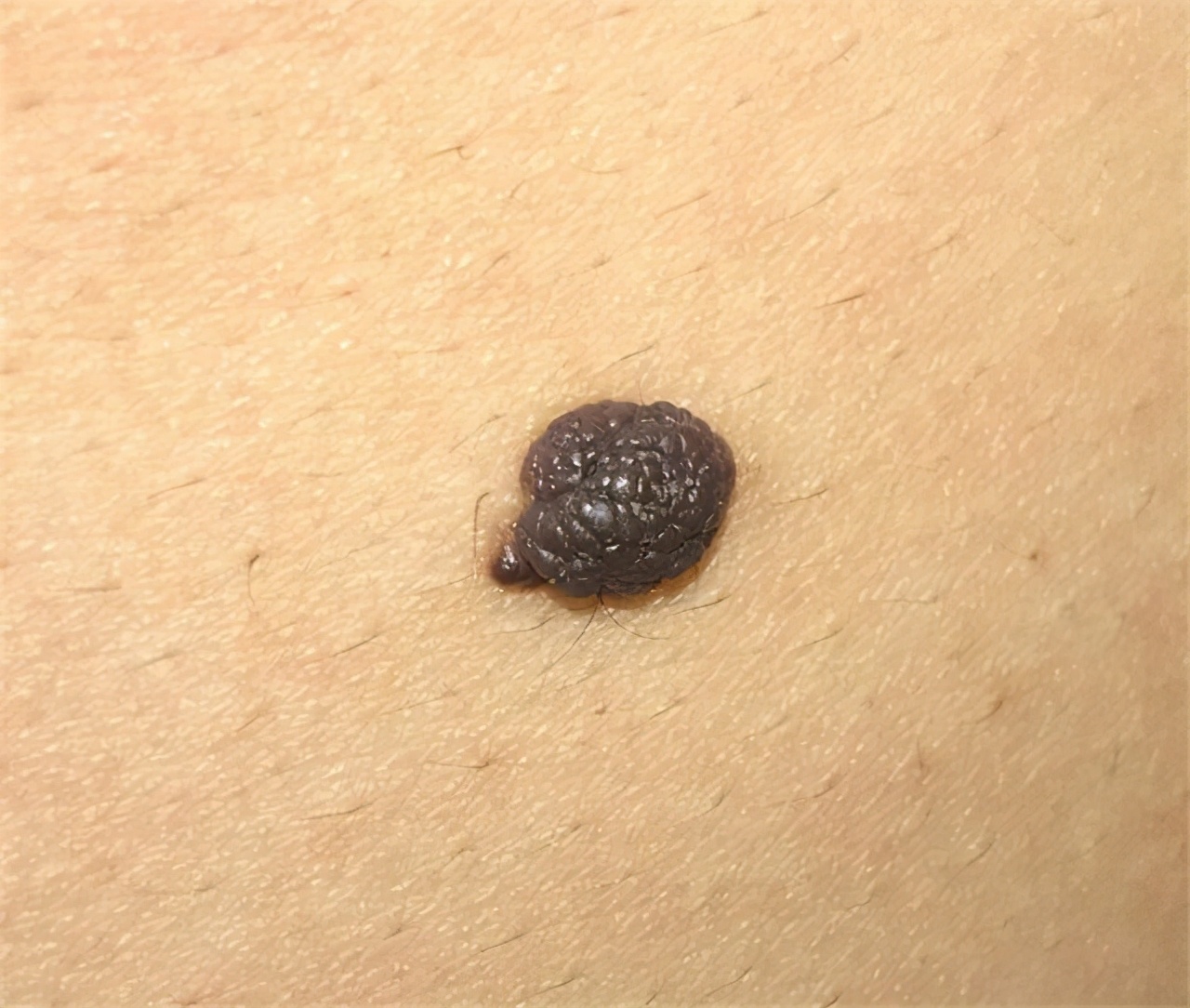 1cm大的黑肉痣是黑色素瘤吗,小孩黑色素瘤和痣的区别