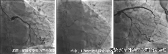 激光冠脉斑块消蚀术费用,冠脉介入手术去除冠脉钙化斑块吗