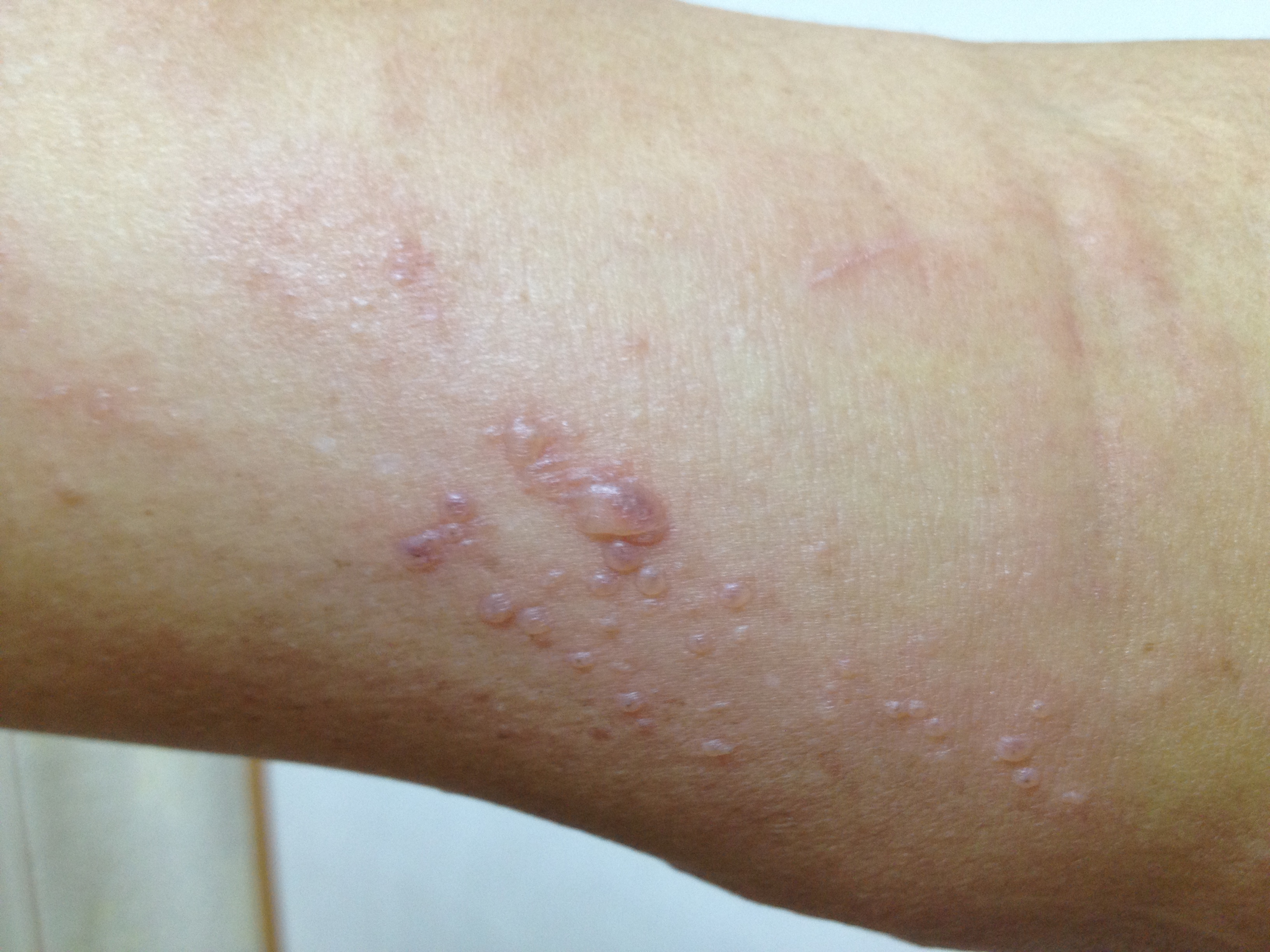 门诊日记全集,带状疱疹入院记录范文