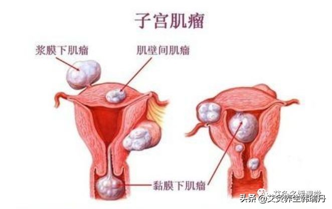 子宫肌瘤结节能治愈吗,肌瘤结节症状