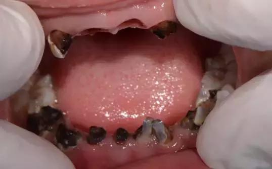 预防儿童蛀牙可打针预防吗,预防蛀牙可做窝沟封闭