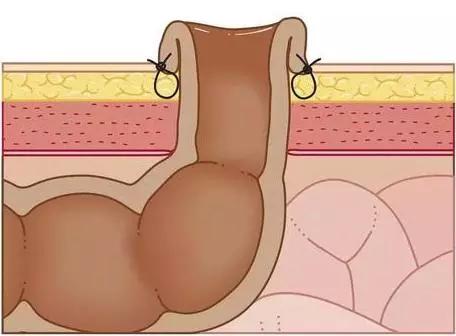 灌肠可以排毒养颜吗,灌肠疗法排毒是智商税吗