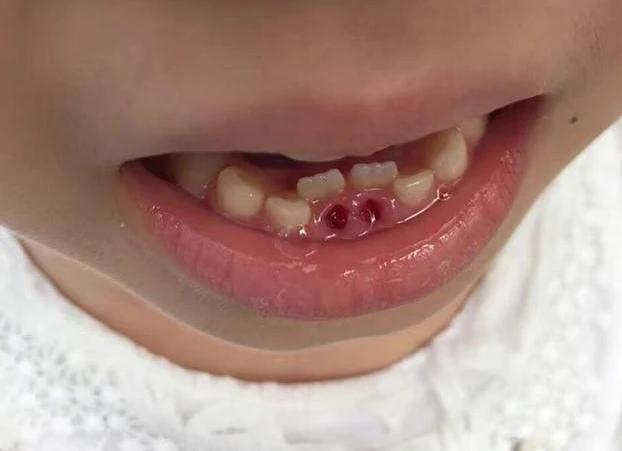 6岁娃长双排牙是怎么回事,6岁孩子长出双排牙