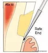 改变刷牙方式楔状缺损就会停止吗,刷牙导致楔状缺损牙齿会断么