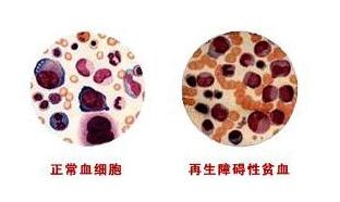 血液科病人预防出血措施,再障这种恶性血液病该怎么预防