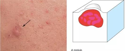 痘痘为什么越来越多如何正确祛痘,祛痘痘的效果是长痘痘还是消痘痘