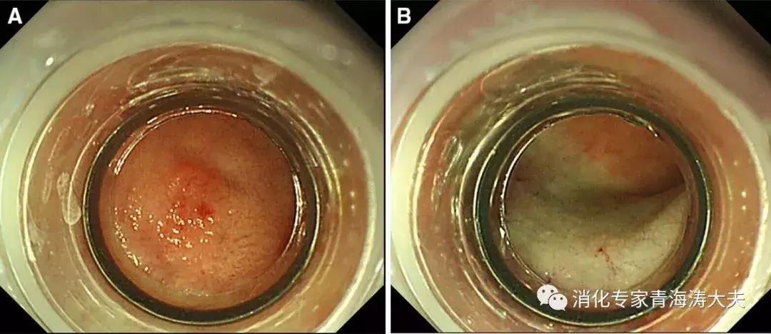 十二指肠神经内分泌瘤低度恶性,胰十二指肠切除术教学查房