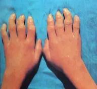 大骨节病科普视频,关于膝盖痛你了解多少