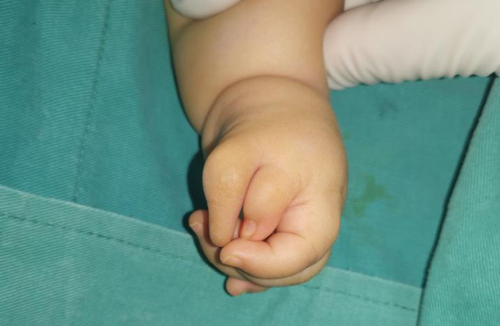 拇指多指手术后怎么护理,拇指漂浮指治疗康复案例