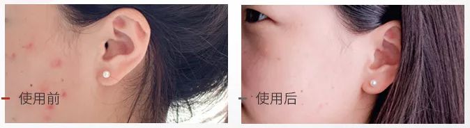 用这款植物香皂洗脸，3周除螨93.77%，痘痘明显改善，湿润不紧绷