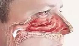 儿童鼻痒鼻塞鼻炎用什么喷剂,鼻腔缓解喷雾