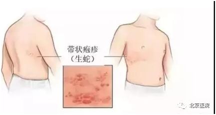中国镇痛周你了解多少,带状疱疹神经痛哪种药镇痛效果好