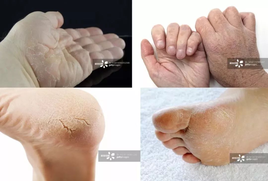 手上冻疮干裂怎么办,手脚冻脸上冻疮三天快速消除
