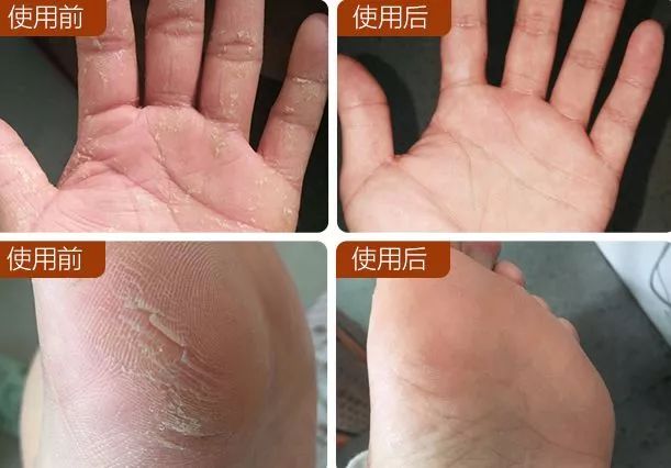 手上冻疮干裂怎么办,手脚冻脸上冻疮三天快速消除