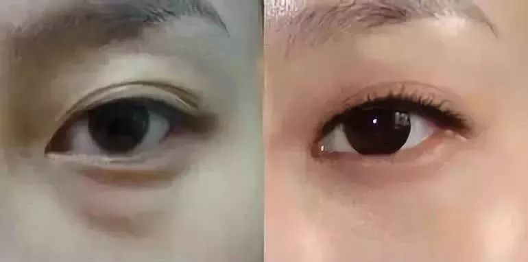 430年马应龙非遗中药眼膜，保密古方，一敷秒去大眼袋