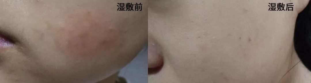 如何拯救长痘的脸,长痘肌肤日常如何护理