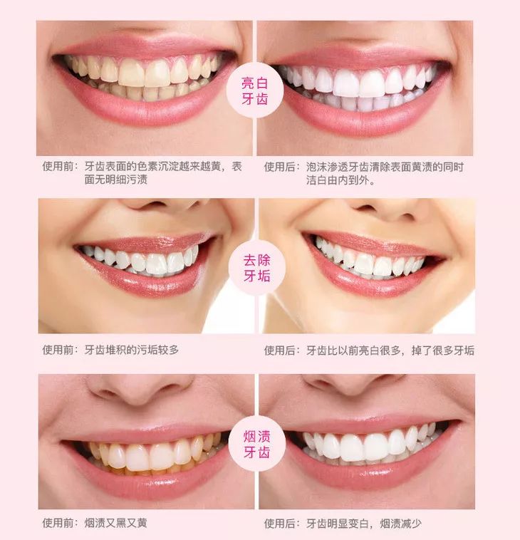 用了美白牙膏白了一颗牙,用了美白牙膏后还用清洁吗