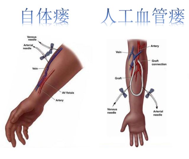 透析病人内瘘胀痛是怎么回事,透析病人内瘘血栓形成如何处理