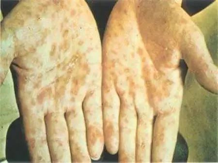 男子梅毒的10个征兆,患了梅毒是不是一定要彻底治愈