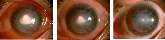 孙旭光眼科医生,孙旭光大夫角膜塑形镜危害