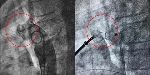 心脏血管外科手术,先天性心脏病介入诊治及进展
