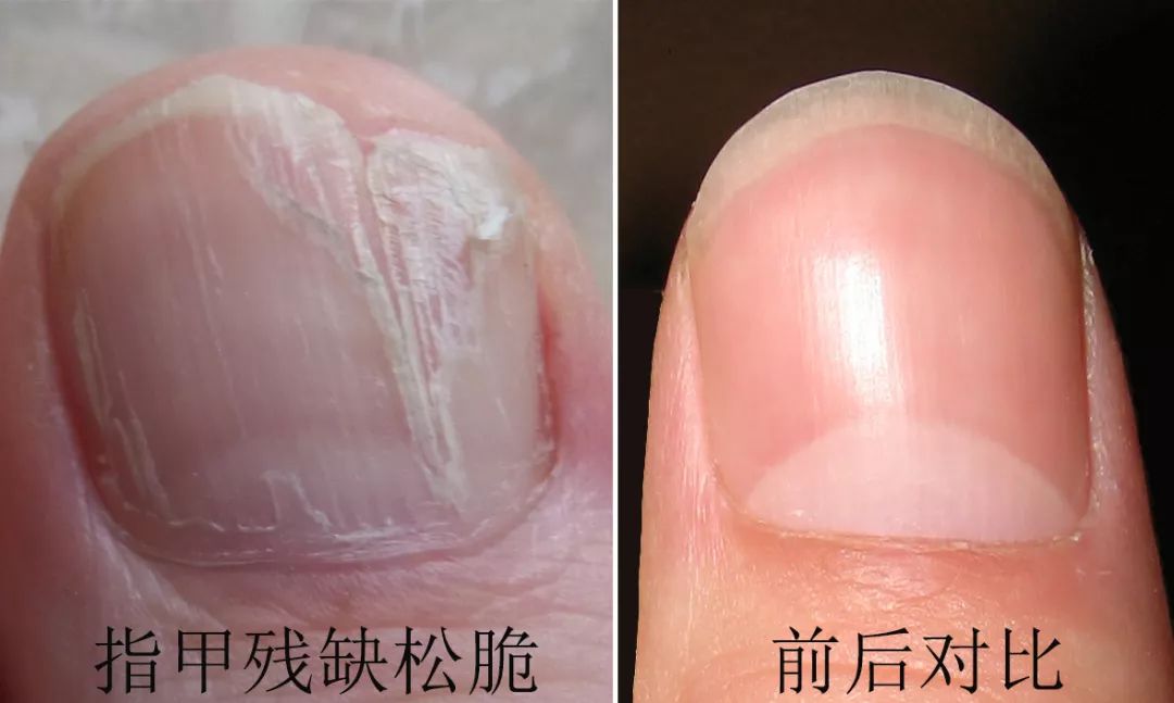 十年灰指甲可以治好吗,一次搞定顽固灰指甲