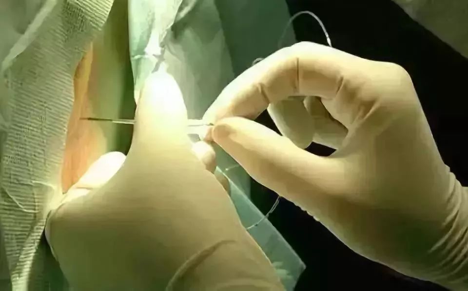 无痛分娩全国推广试点医院,孕妇无痛分娩全国推广