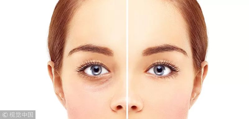 去掉眼袋之后天壤之别,无美颜无滤镜遮泪沟眼袋