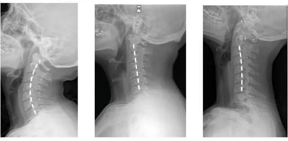 拯救颈椎神器,保护颈椎最好的神器